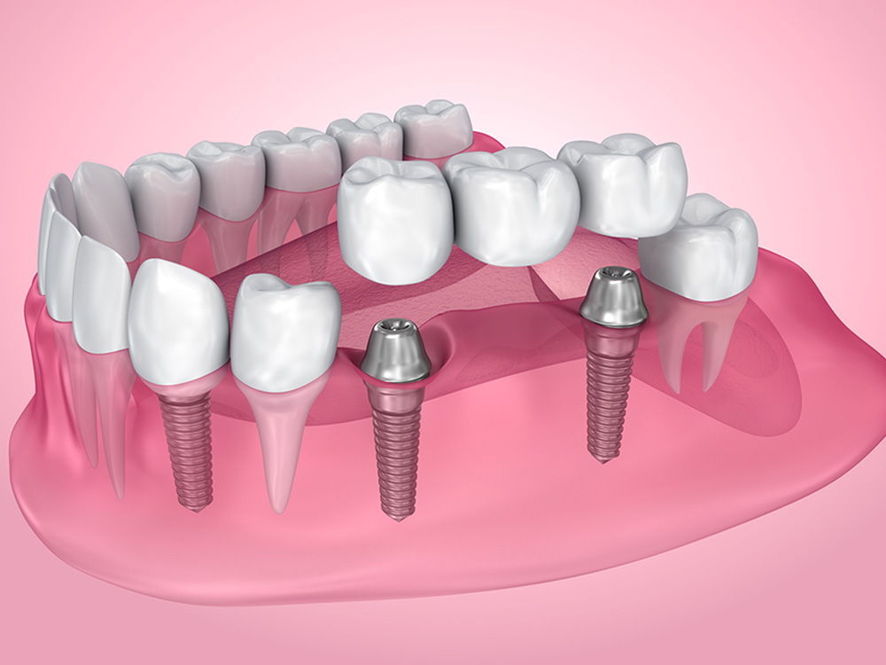 dental bridges in georgetown