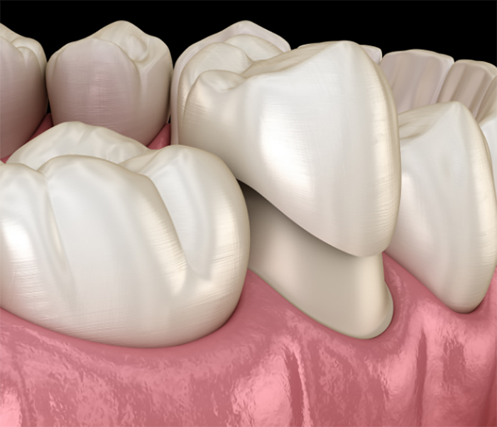 dental crowns in georgetown