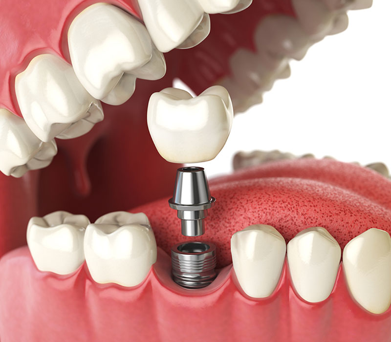 dental implants in georgetown