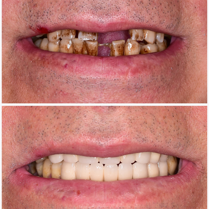 full mouth reconstruction in georgetown