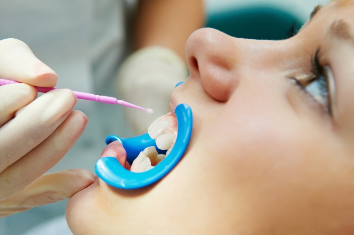 what are dental sealants and how do they protect teeth?