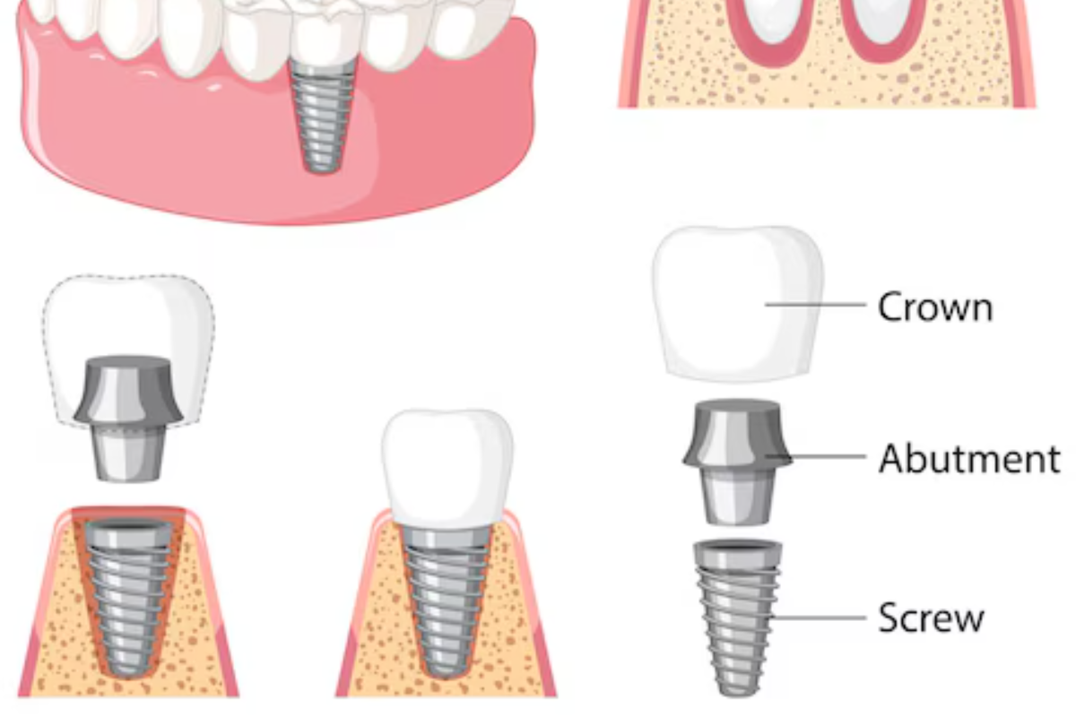quick fixes for broken dental crowns