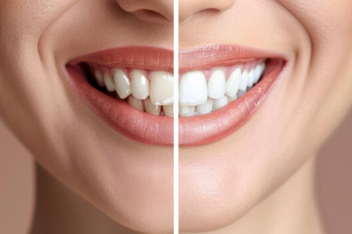 safely whitening your teeth: what you need to know