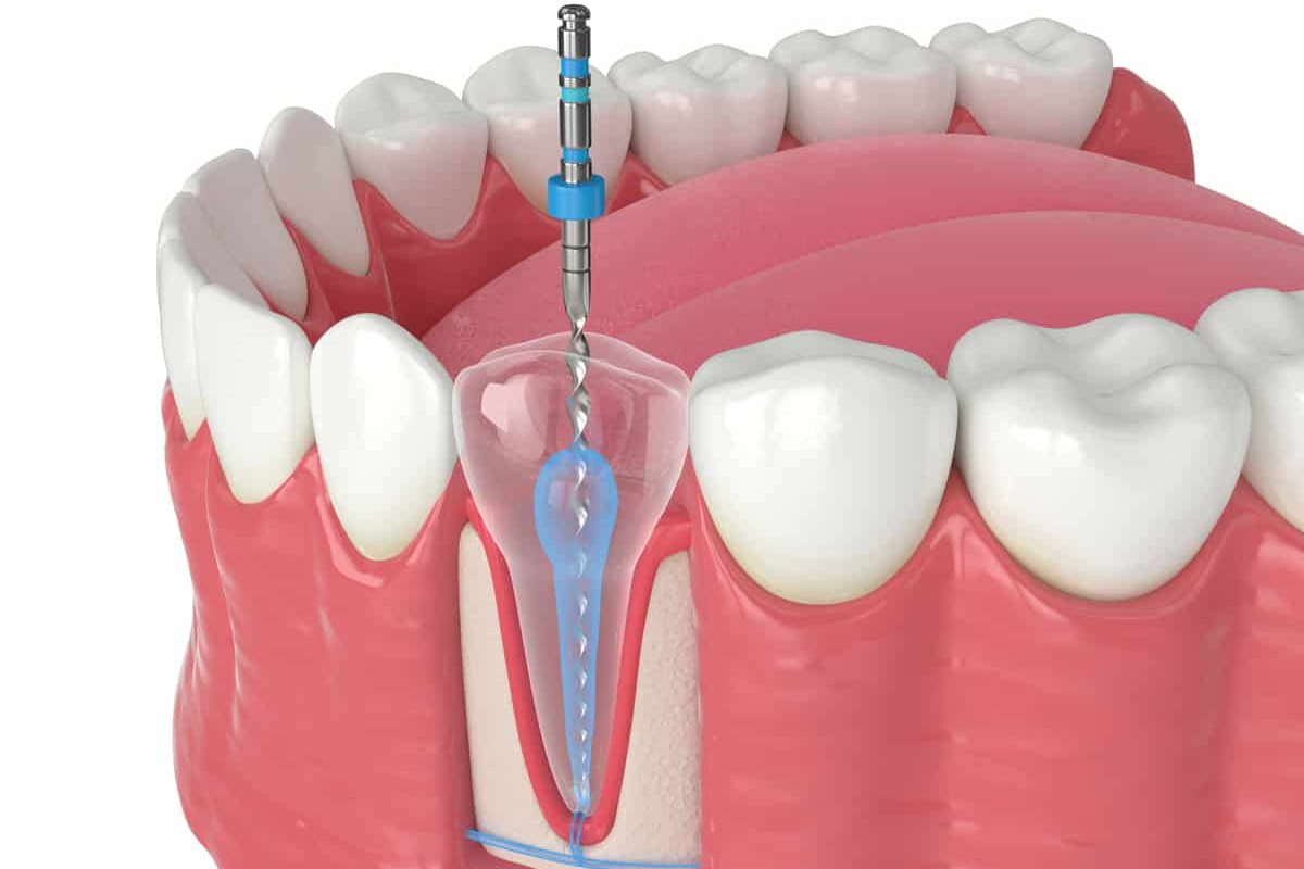 minimally invasive procedure for pain free root canal