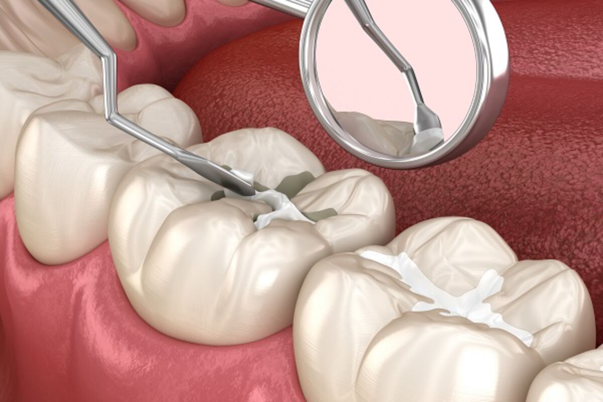 benefits of dental sealants for children