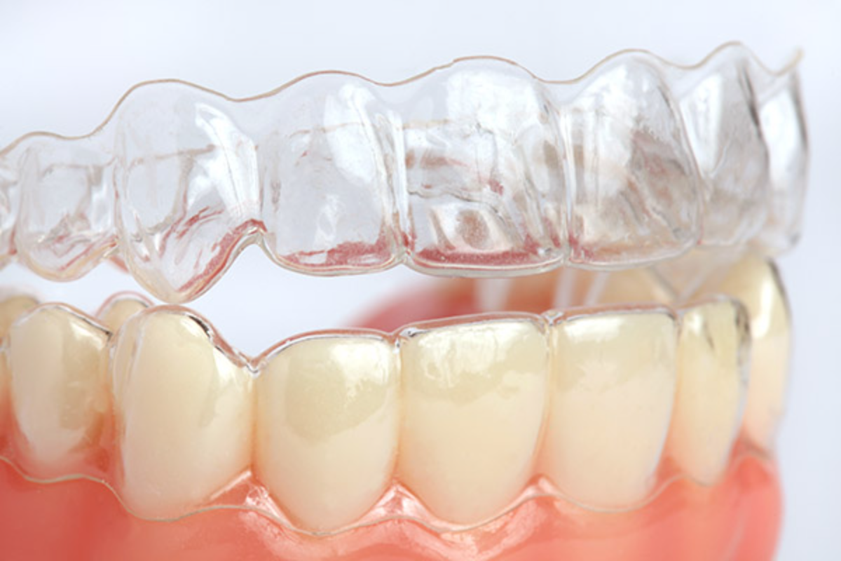 things to kow before starting invisalign journey