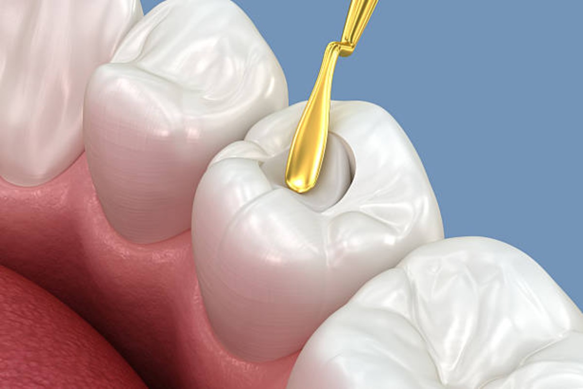 do dental sealants hurt