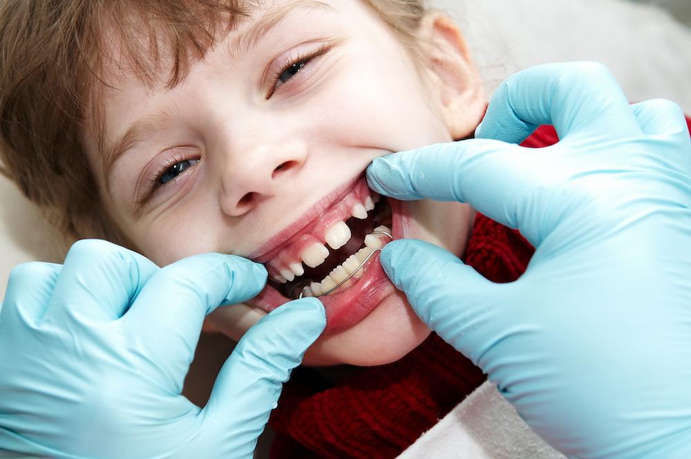 sealants for baby teeth