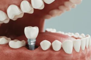 single-vs-multiple-tooth-implants-explained